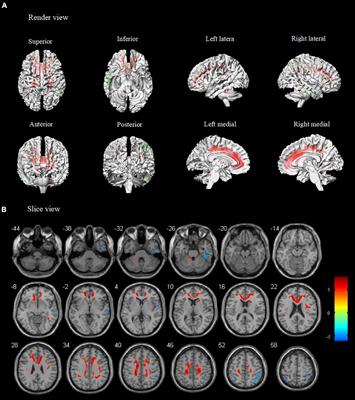 Alterations in Cortical-Subcortical Metabolism in Temporal Lobe Epilepsy With Impaired Awareness Seizures